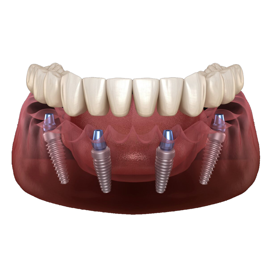 Rehabilitación completa con implantes dentales