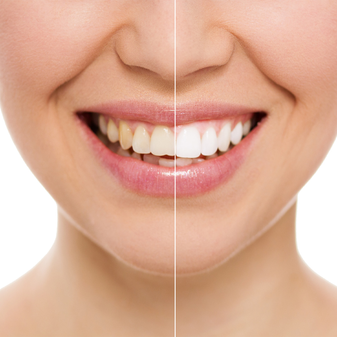 Blanqueamiento Dental Avanzado