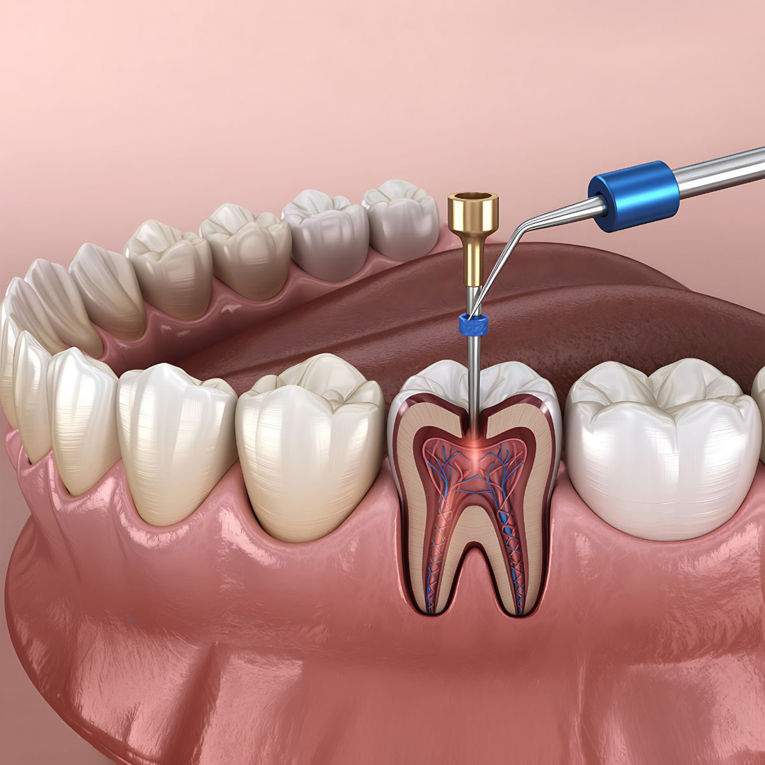 Paso 2: Limpieza y desinfección en Endodoncia