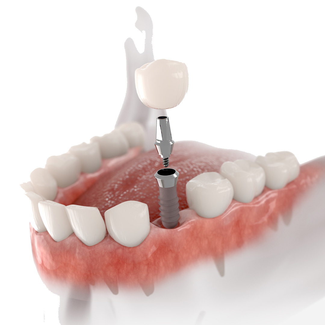 Implante Dental Unitario