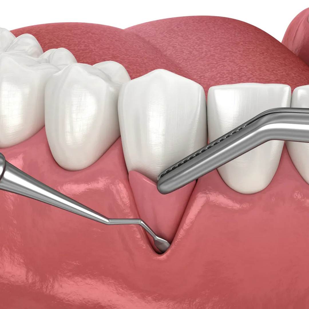 Paso 3: Microcirugía Periodontal y Regeneración