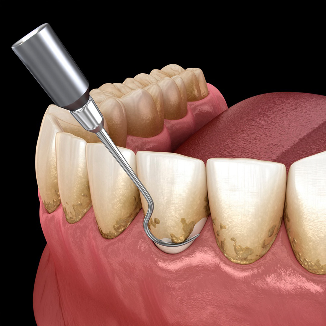 Paso 2: Limpieza Profunda o Curetaje periodontal