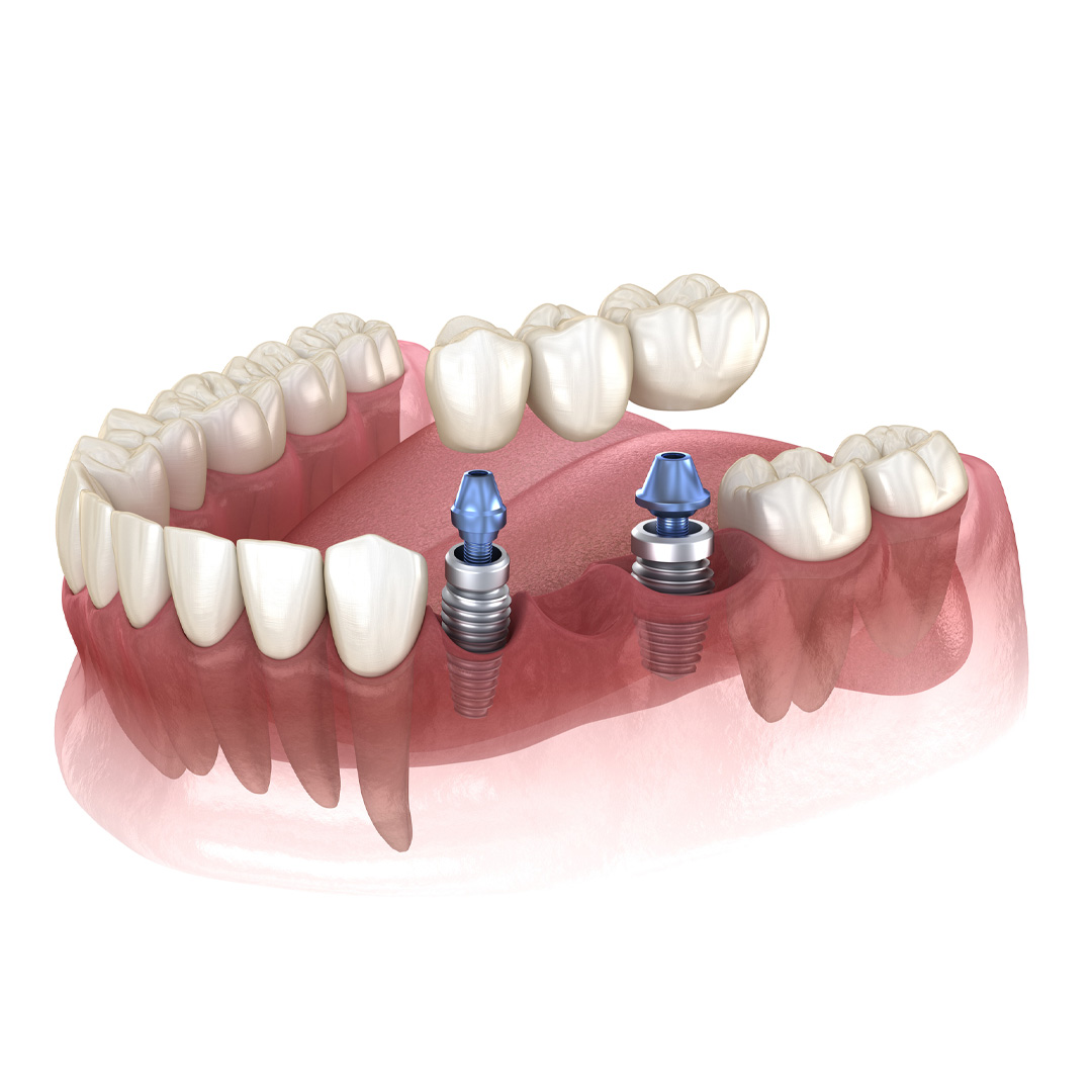 Puente dental sobre implantes